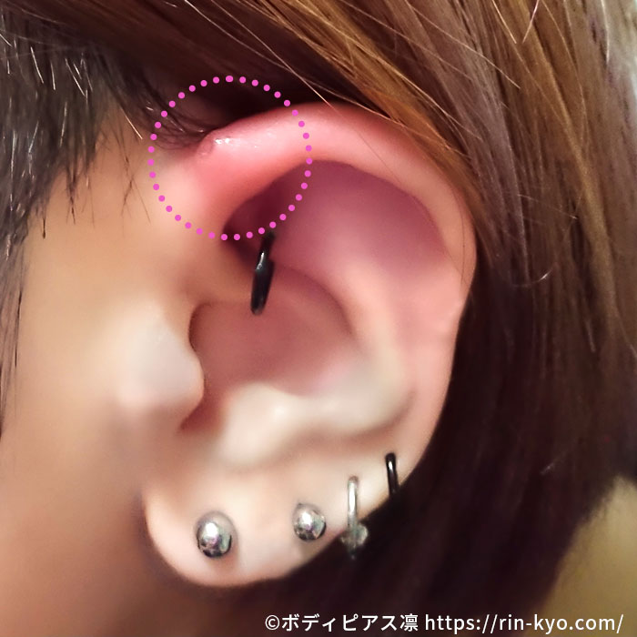 炎症を起こしているピアスホール