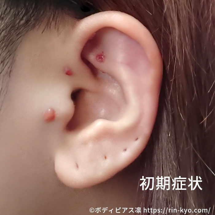 ピアスの肉芽初期症状