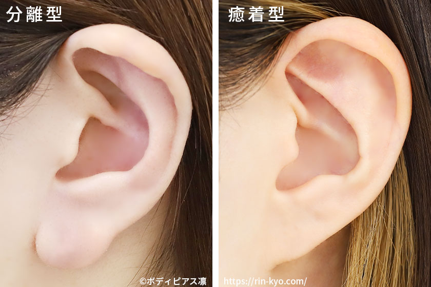 分離型と癒着型の耳たぶ